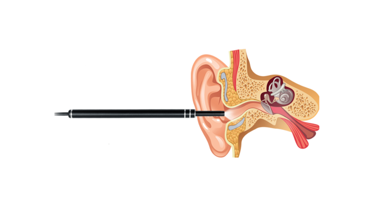 OptiLookNPick Reviews: A Simple And Safe Method To Inspect Inner Ears!